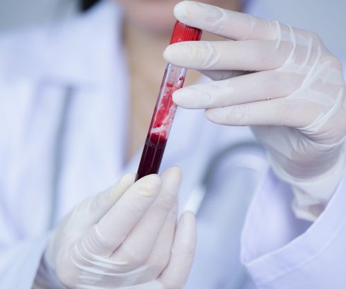 Rekomendacijos prieš kraujo ėmimą tyrimams